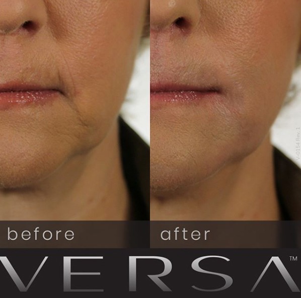 Revanesse Versa Dermal Filler Beverly Hills | Los Angeles | West